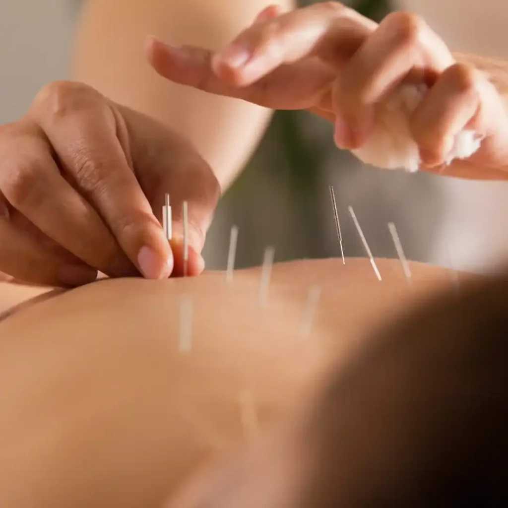 acupuntura terapia vigorosamente 01